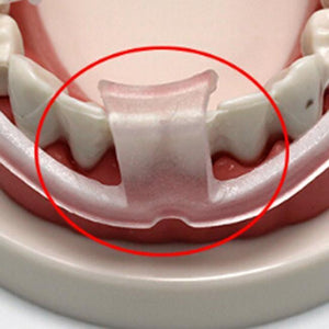 Aufbissschiene von Xceldent - gegen Zähneknirschen